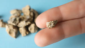 non surgical kidney stone treatment